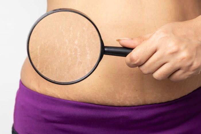 Rekomendasi Produk Untuk Menghilangkan Stretch Mark