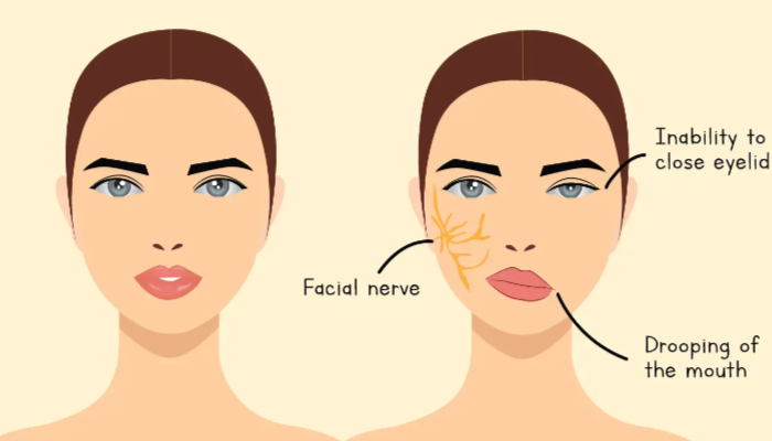 Penyebab Bell's Palsy Dari Penggunaan Kipas Angin, Benarkah?