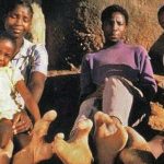 Suku Doma, Punya Kelainan Genetik Mirip Kaki Burung Unta