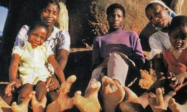 Suku Doma, Punya Kelainan Genetik Mirip Kaki Burung Unta