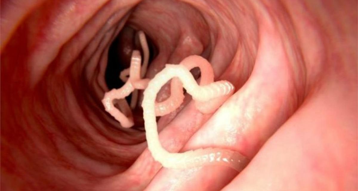 Cara Mengeluarkan Parasit Dalam Tubuh Secara Alami