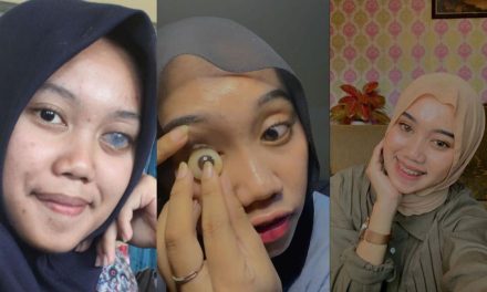 Protesa Mata Ternyata Juga Memiliki Risiko Buruk, Ketahui Yuk!