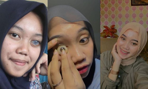 Protesa Mata Ternyata Juga Memiliki Risiko Buruk, Ketahui Yuk!