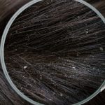 Rambut Berketombe Bikin Gak Pede!, Ini Cara Mengatasinya!