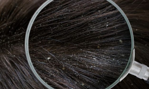 Rambut Berketombe Bikin Gak Pede!, Ini Cara Mengatasinya!
